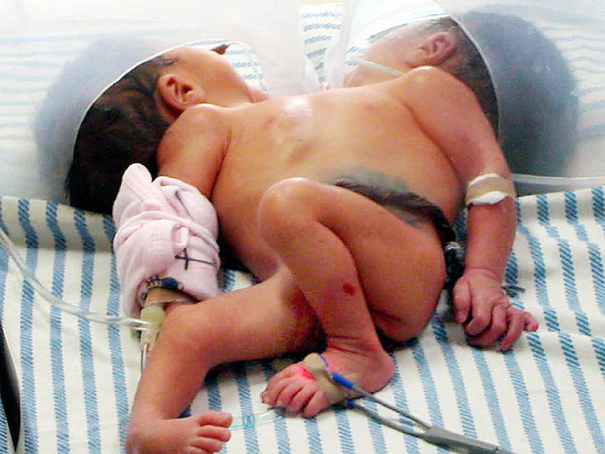 Conjoined Twins Warning Graphic Images