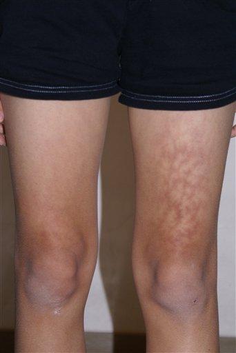 Toasted Leg Syndrome 
