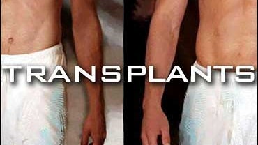 A Suspected Killer Who Damaged His Liver During A Botched Suicide Attempt Receives Trasplant  