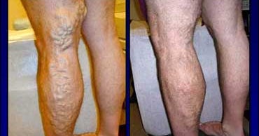 Erase Varicose Veins With Lasers CBS News