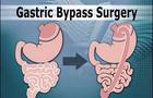 Gastric Bypass Surgery 
