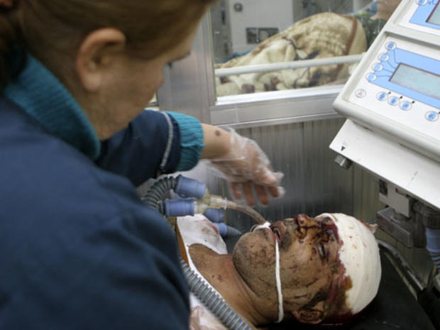 A victim of a suicide bomb attack recovers in a central Baghdad, Iraq, hospital on Tuesday, Jan. 1, 2008. 