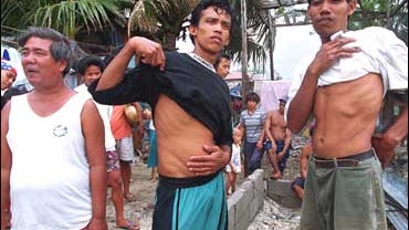 Dalmacio Zeta Jr., left, explains how people sell their organs in Manila, Philippines, as Norberto Papa, center, and Napoleon Custodio show their scars from a kidney operation. 