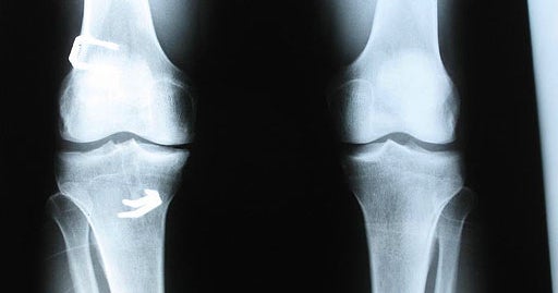 Knee injuries on the rise in young athletes CBS News