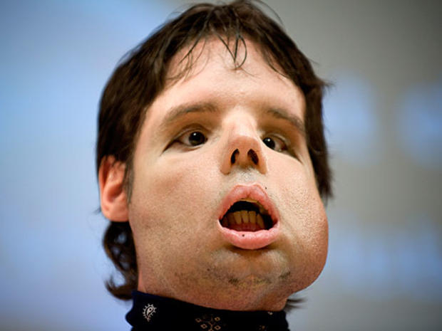 Oscar, a man who underwent a full-face transplant in April, poses for the photographers as he appears in public for the first time in a news conference at the Vall d&amp;amp;#39;Hebron Hospital in Barcelona, Spain. 