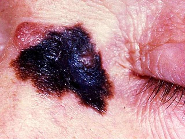 The patient exhibits further signs of basal cell nevus syndrome