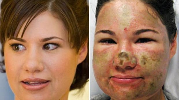 Bethany Storro: Vancouver Acid Attack Victim 
