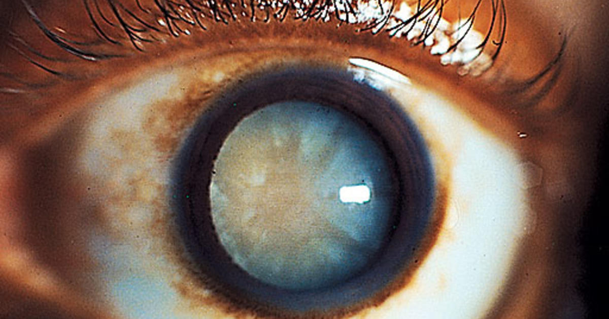Corneal Arcus: What the Ring Around Your Cornea Means