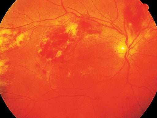 HIV-AIDS retinitis