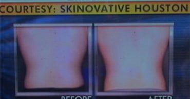 Non-Lipo Love-Handle Reducers OK'd by FDA - CBS News