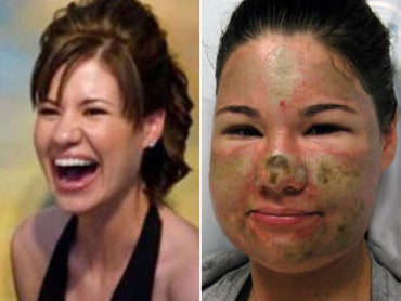 Acid Attack Hoax: Bethany Storro Pleads Not Guilty to Theft 