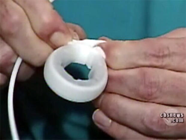 A gastric band is seen after a Food and Drug Administration advisory panel recommended that gastric band surgery be made more available to weight loss patients. 