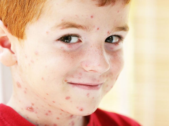 chickenpox, chicken pox, generic, 4x3 