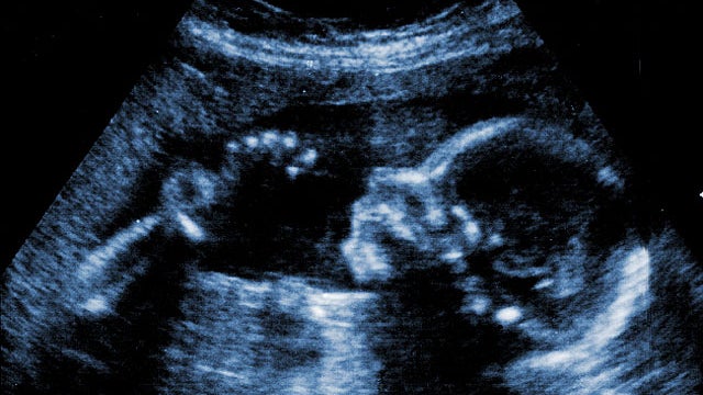 fetus, embryo, sonogram, generic, 4x3 