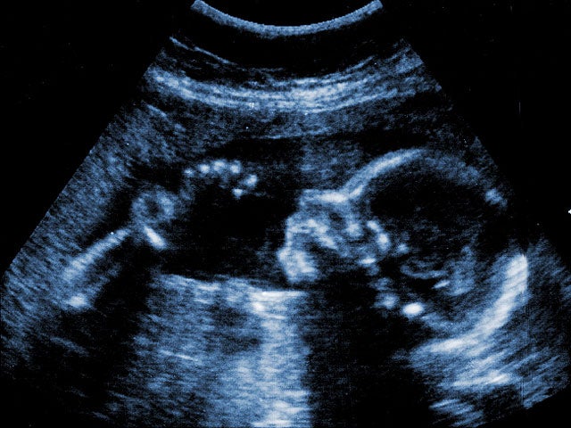 fetus, embryo, sonogram, generic, 4x3