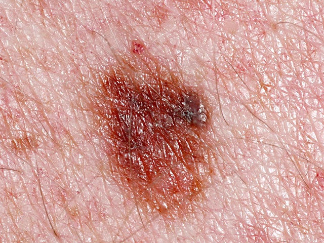 Is it skin cancer?