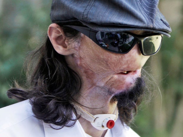 Dallas Wiens, who received a face transplant, talks on Oct. 13, 2010, months before procedure.