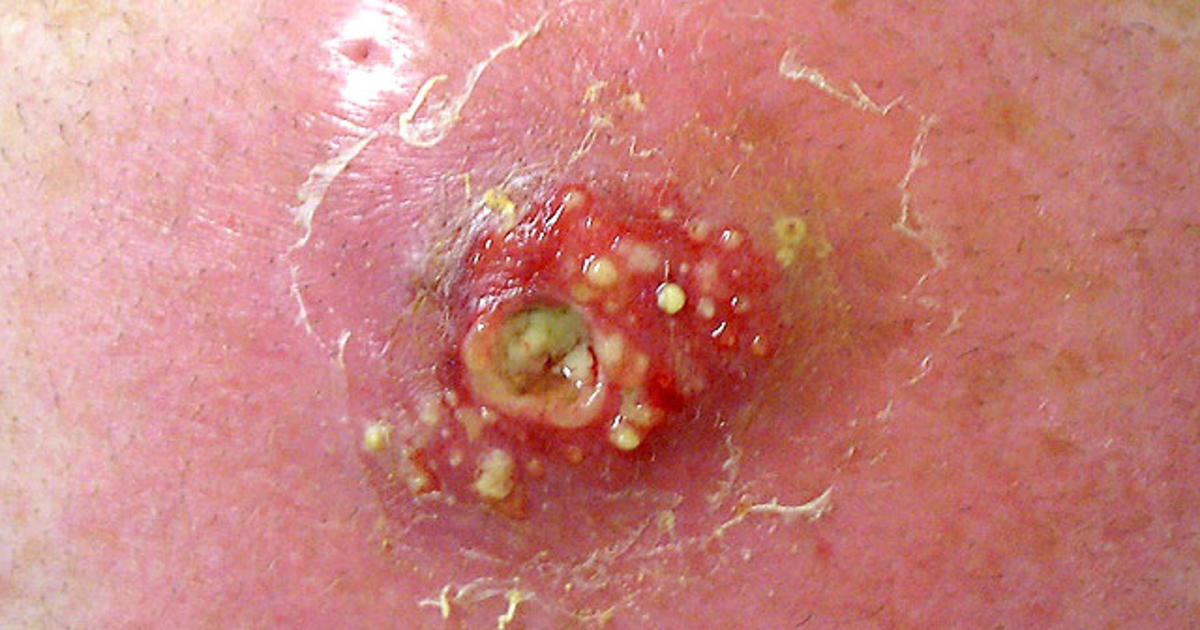 Deadly skin infection? 12 graphic photos that could save your life