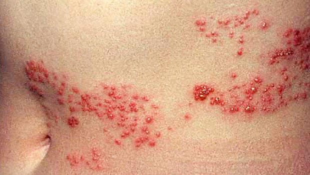 Is it shingles? 7 myths about painful illness (graphic images) 