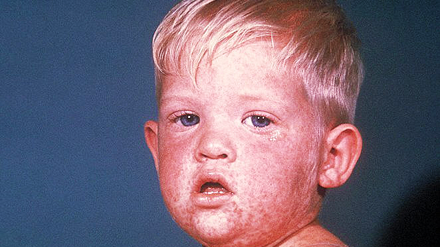 measles3.jpg 