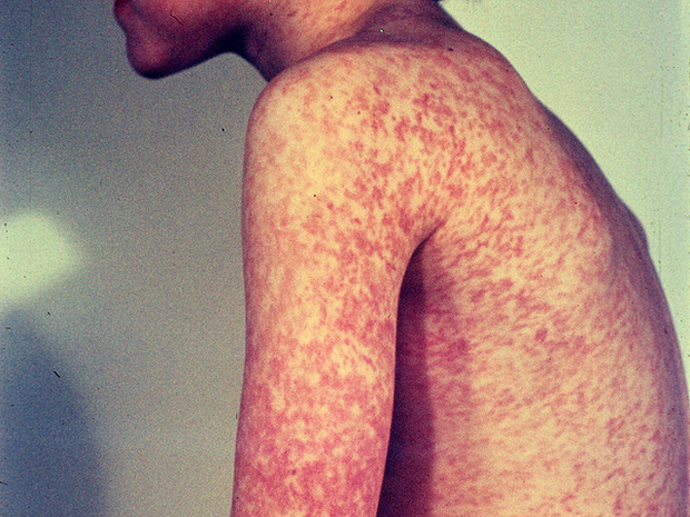 measles9.png 