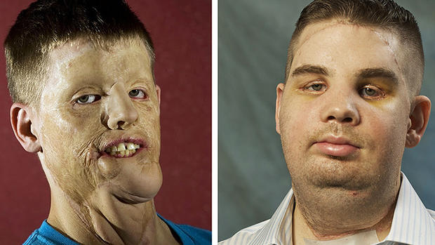 Mitch Hunter's amazing new face: Transplant patient leaves hospital 
