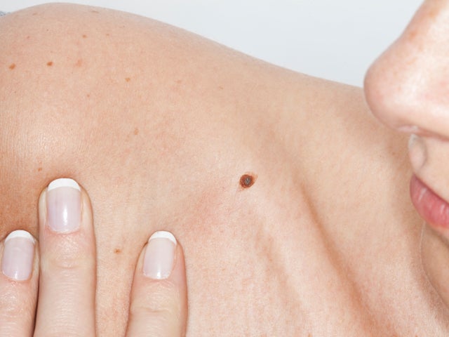 Study: New drugs boost melanoma survival 