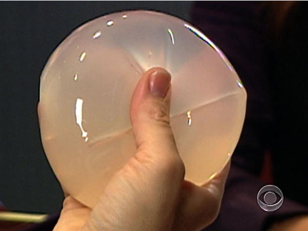 FDA: Breast implants don't last forever 