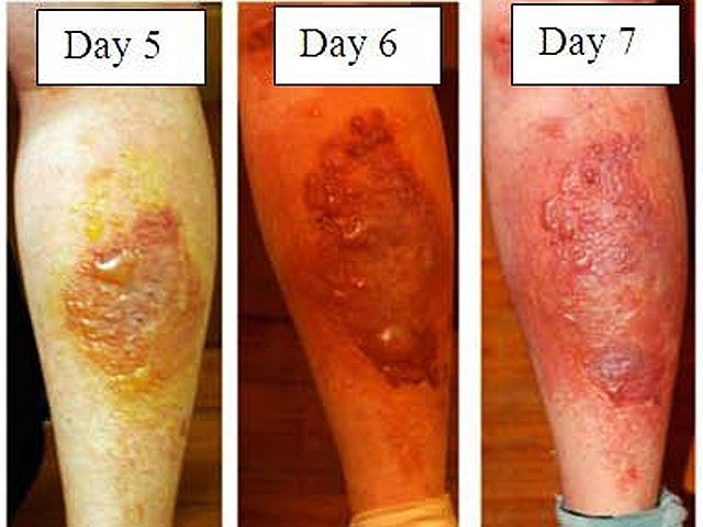 hogweedburn_1.jpg