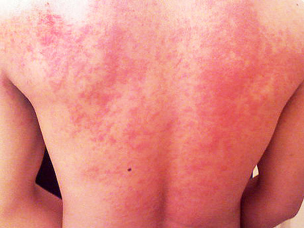 hives, back, rash 