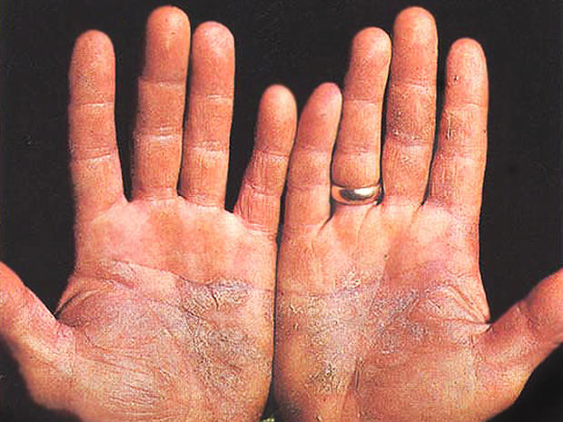 psoriasis, palms, hands 