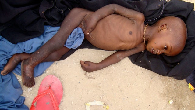 A malnourished child from southern Somalia at a refugee camp in Mogadishu 