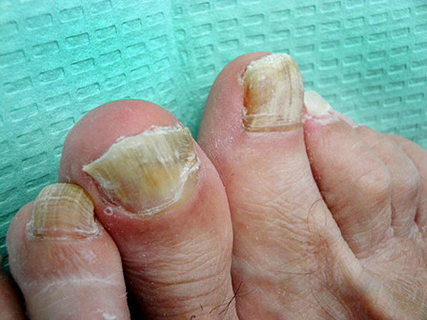 fungal, nail, toenail, foot, fungus 