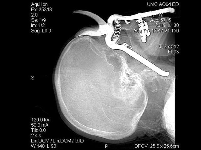 impalement, x-ray, pruning 