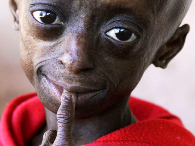 progeria-AP110824079526.jpg 