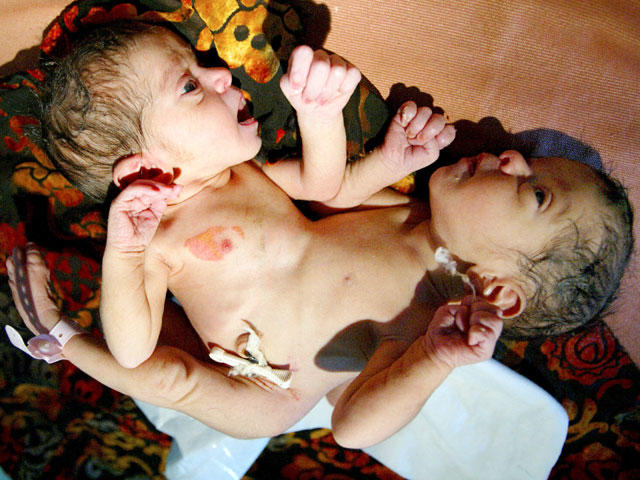 How are the Altobelli conjoined twins doing today? All the details 