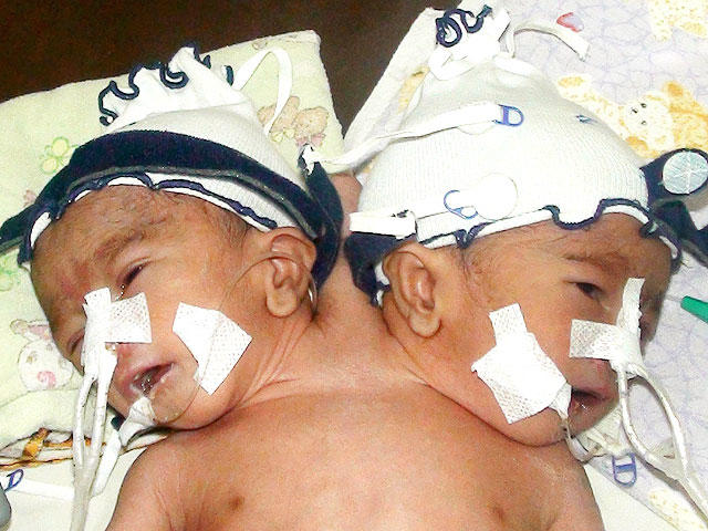 Conjoined twins Abby and Brittany Hensel the chances of survival for such  twins are usually very low but they live to aldulthood and become teachers  - iFunny Brazil