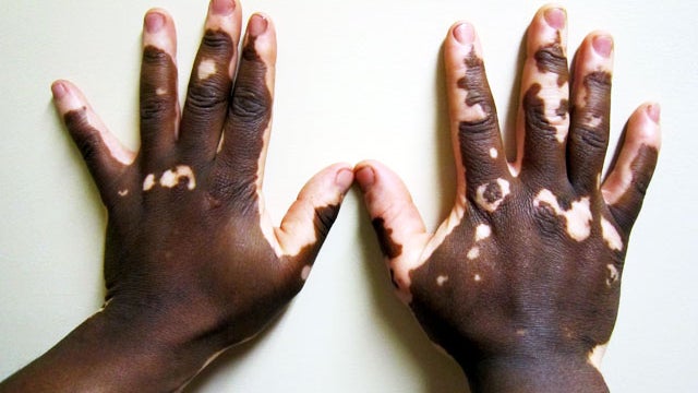 vitiligo 