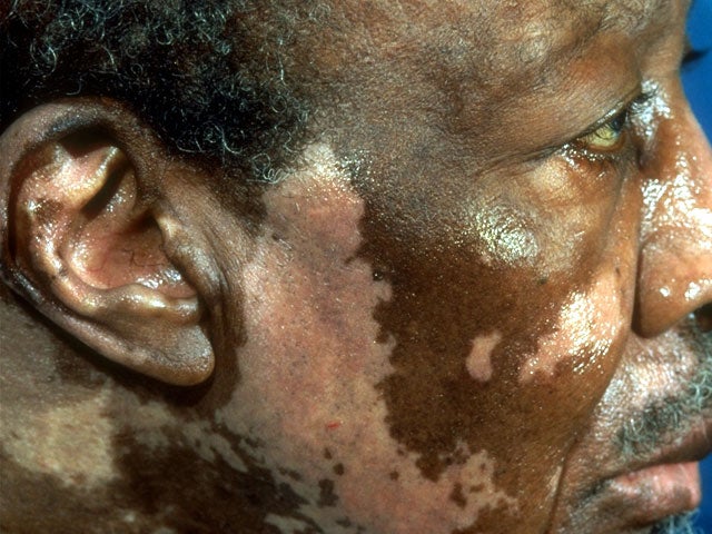 vitiligo 