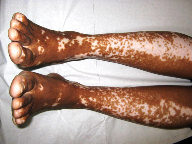vitiligo.jpg 