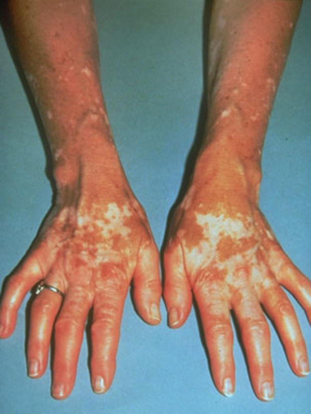 vitiligoarms.jpg 