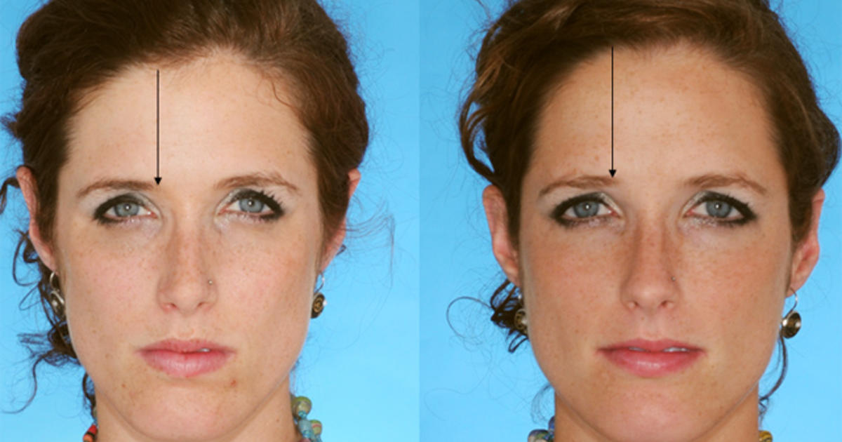 Hairline Lowering Surgery  Forehead Reduction Surgery