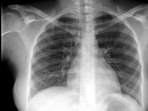 lungs, chest, x-ray, stock, 4x3 