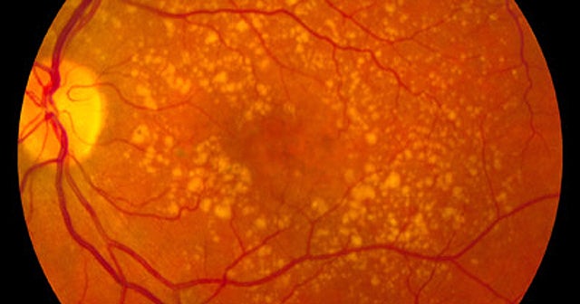 FDA approves Regeneron drug for macular degeneration CBS News