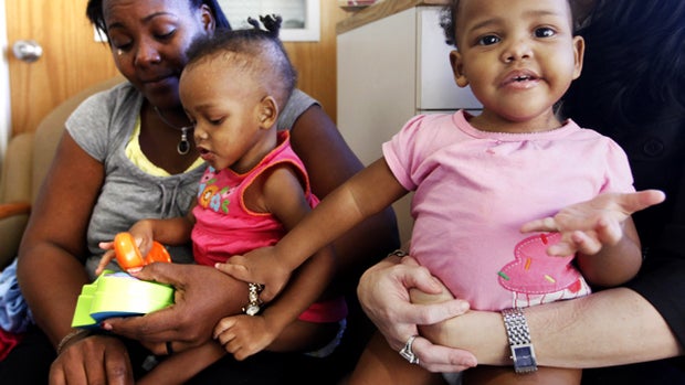 Conjoined twins Maria & Teresa Tapia: Before and after 