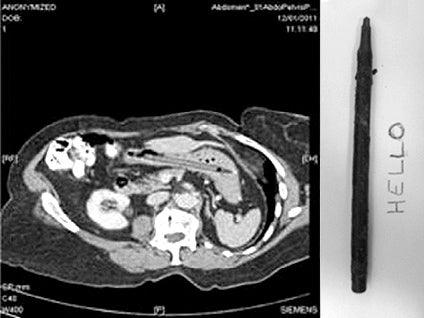 pen-lodged-in-stomach.jpg 