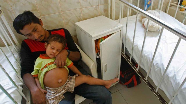 Leonidas Pacunda, Isbac Pacunda, Isbac Pacunda, parasitic twin 