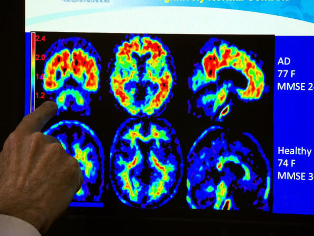 Experimental treatment for Alzheimer's prevention 