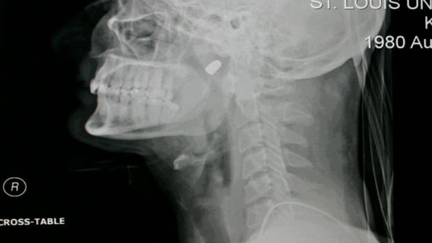 2009 X-ray shows the bullet lodged near Nick Koenigs's spine 