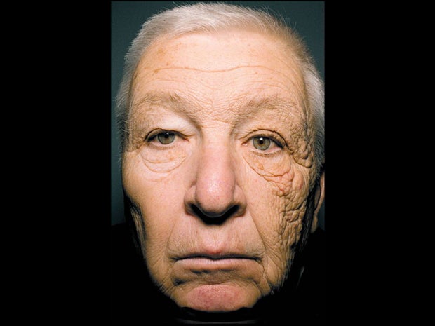 trucker's skin damaged face, uva radiation